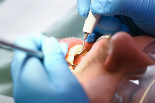 Best Emergency Tooth Extraction in San Jose, CA