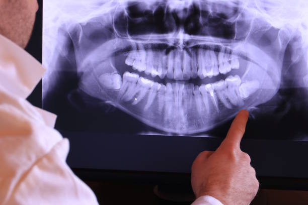 Best Emergency Dental Care for Broken or Chipped Teeth in San Jose, CA