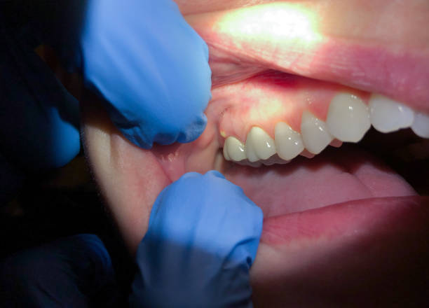 Best Emergency Dental Care for Broken or Chipped Teeth in San Jose, CA