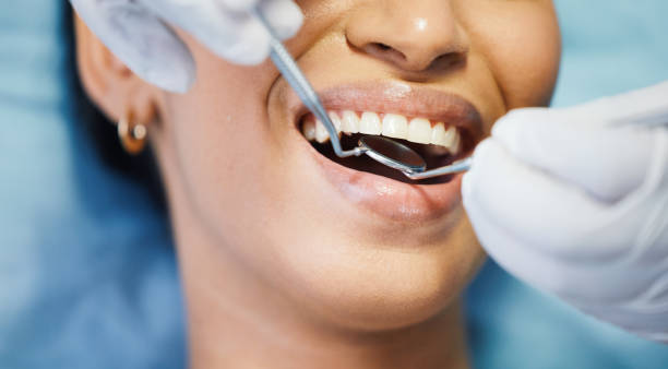 Best Emergency Wisdom Teeth Removal in San Jose, CA